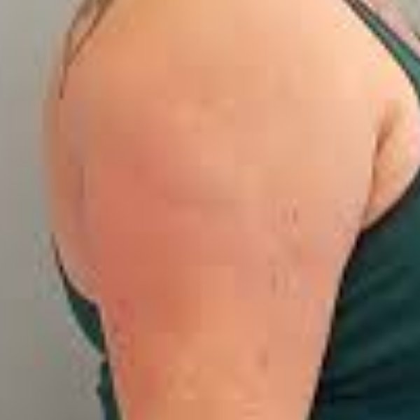 Arm after 3 sessions of non-invasive skin tightening at Create Anew Skin Studio in Scottsdale