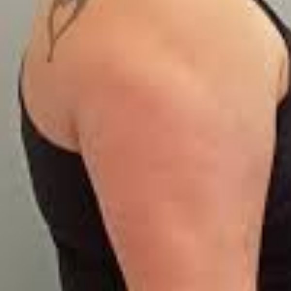Arm before 3 sessions of non-invasive skin tightening at Create Anew Skin Studio in Scottsdale