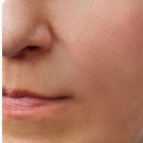 Face after 5 sessions of non-invasive skin tightening at Create Anew Skin Studio in Scottsdale