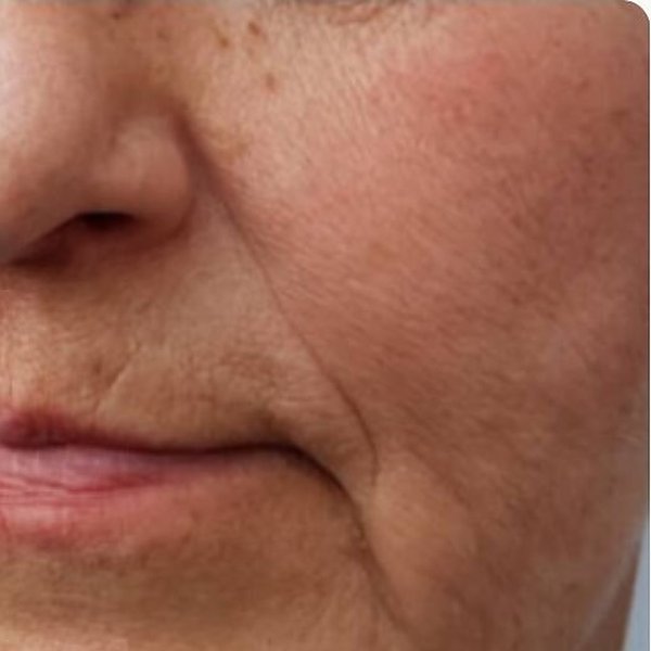 Face before 5 sessions of non-invasive skin tightening at Create Anew Skin Studio in Scottsdale