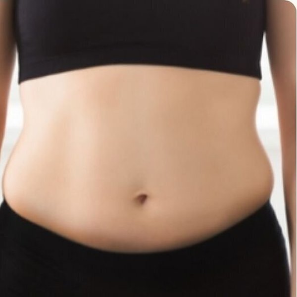 Stomach before 6 sessions of non-invasive body sculpting at Create Anew Skin Studio in Scottsdale